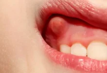 Blood Blister on Tongue