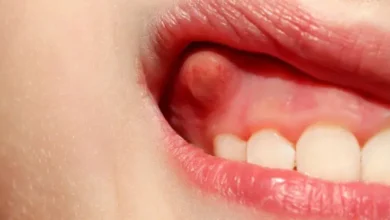 Blood Blister on Tongue